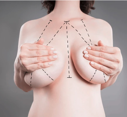 Breast lift consultation with patient and surgeon