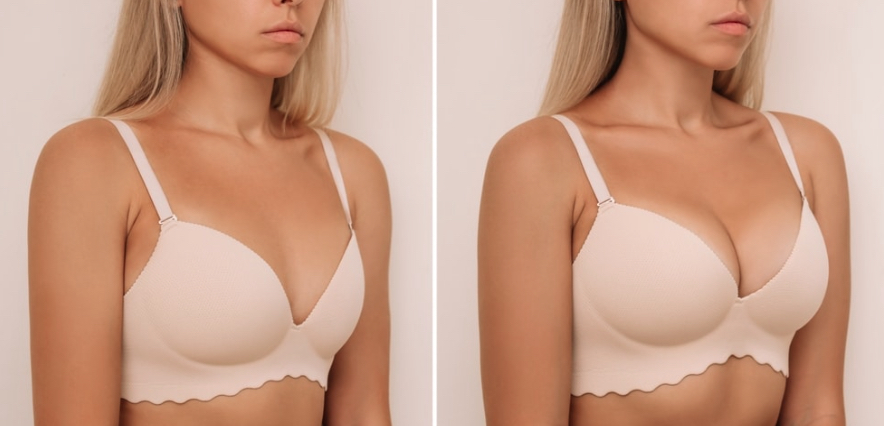 Breast augmentation consultation and planning discussion