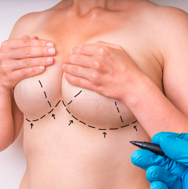 Breast reduction follow up consultation and recovery discussion