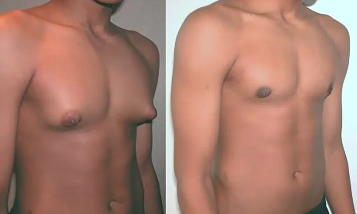 Gynecomastia consultation and male chest contour evaluation