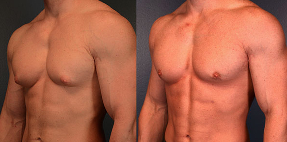 Gynecomastia follow up consultation and recovery discussion