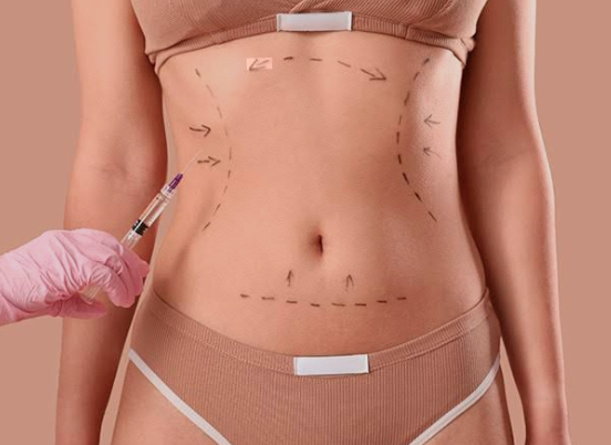 Tummy tuck consultation and abdominal contour planning