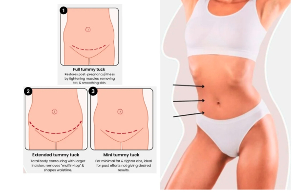 Extended tummy tuck consultation and surgical planning