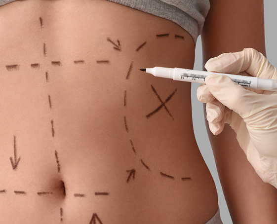 Extended tummy tuck consultation and contour treatment planning