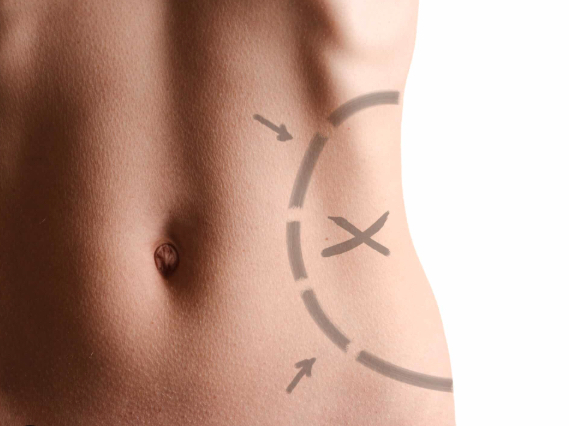 Belt lipectomy consultation and lower body contour planning