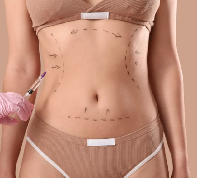Liposuction consultation and body contour planning
