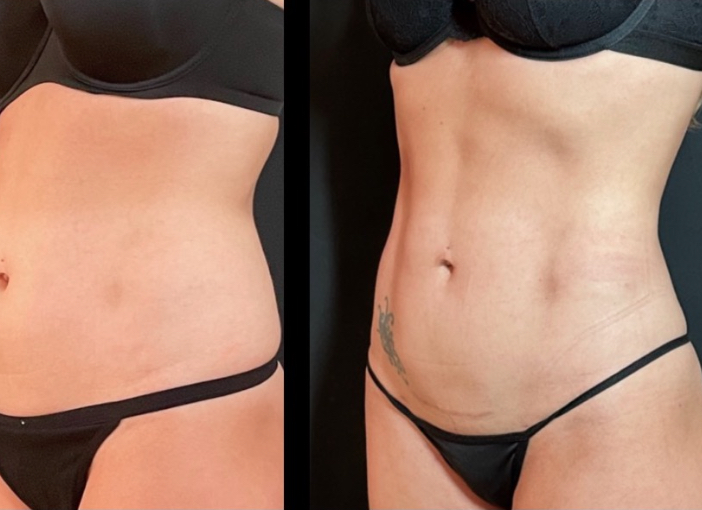 Liposuction consultation and body contour planning