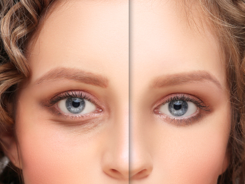 Blepharoplasty consultation and eyelid treatment planning