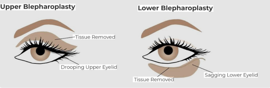 Blepharoplasty consultation and eyelid evaluation