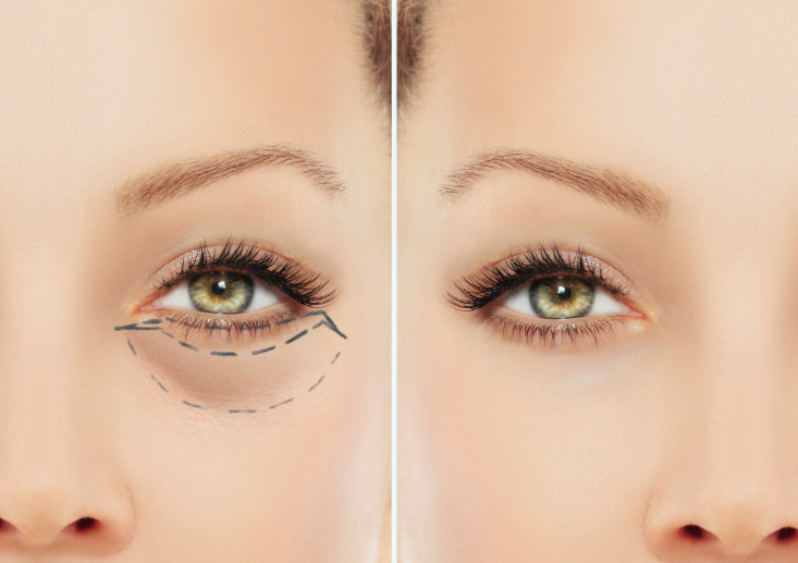 Blepharoplasty consultation and eyelid surgery planning