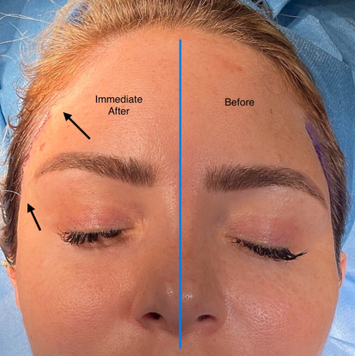 Eyebrow lift consultation and treatment planning