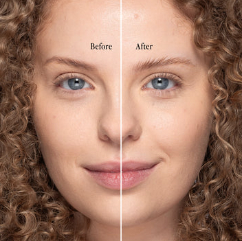 Eyebrow lift consultation and surgical planning