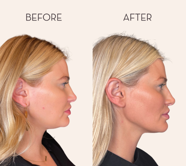 Face lift consultation and candidacy assessment